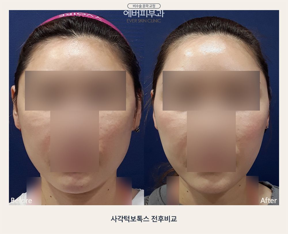 Masseter Botox before and after