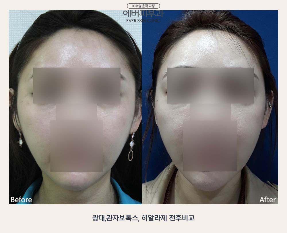 Slim Face Contouring before and after