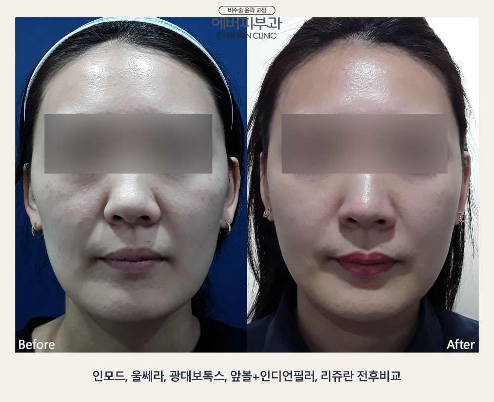 Filler + Ulthera Contouring before and after