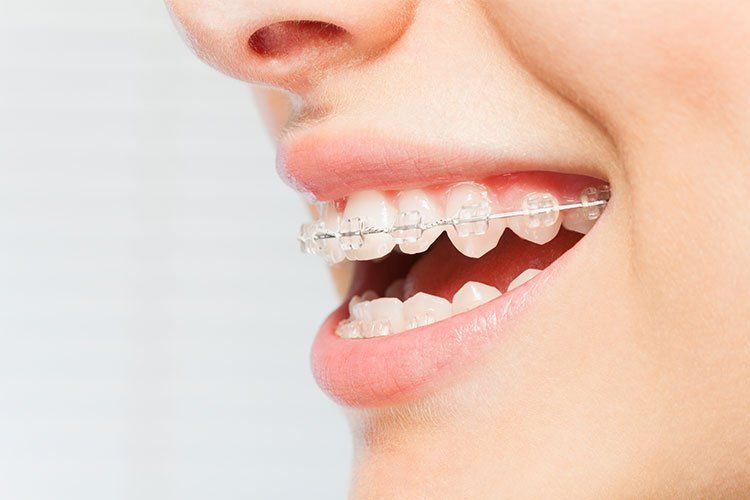 Close-up of a smiling mouth with clear orthodontic braces on the teeth