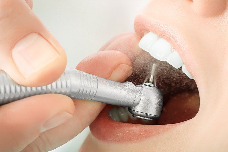 Dental drill working on a patient's molar inside an open mouth