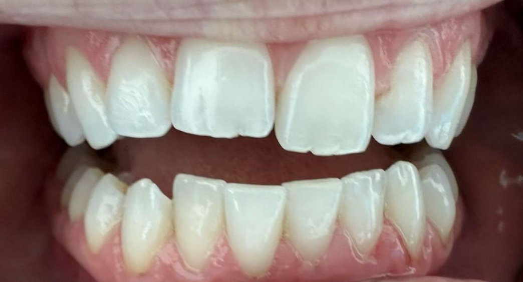 Close-up of a smiling mouth showing white upper and lower teeth with a gap between the front teeth