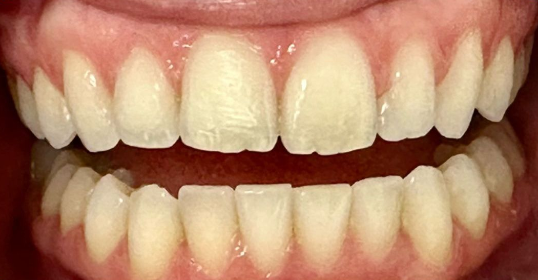 Close-up of slightly open mouth showing upper and lower teeth and pink gums
