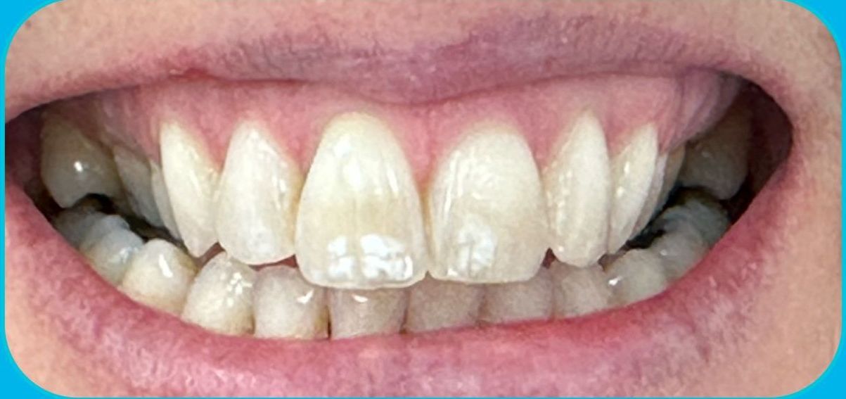 Close-up of a smiling mouth showing slightly misaligned front teeth.