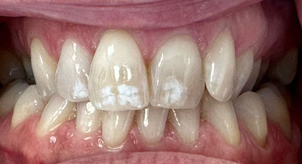 Close-up of teeth with visible white discoloration and crowded front teeth in an open mouth