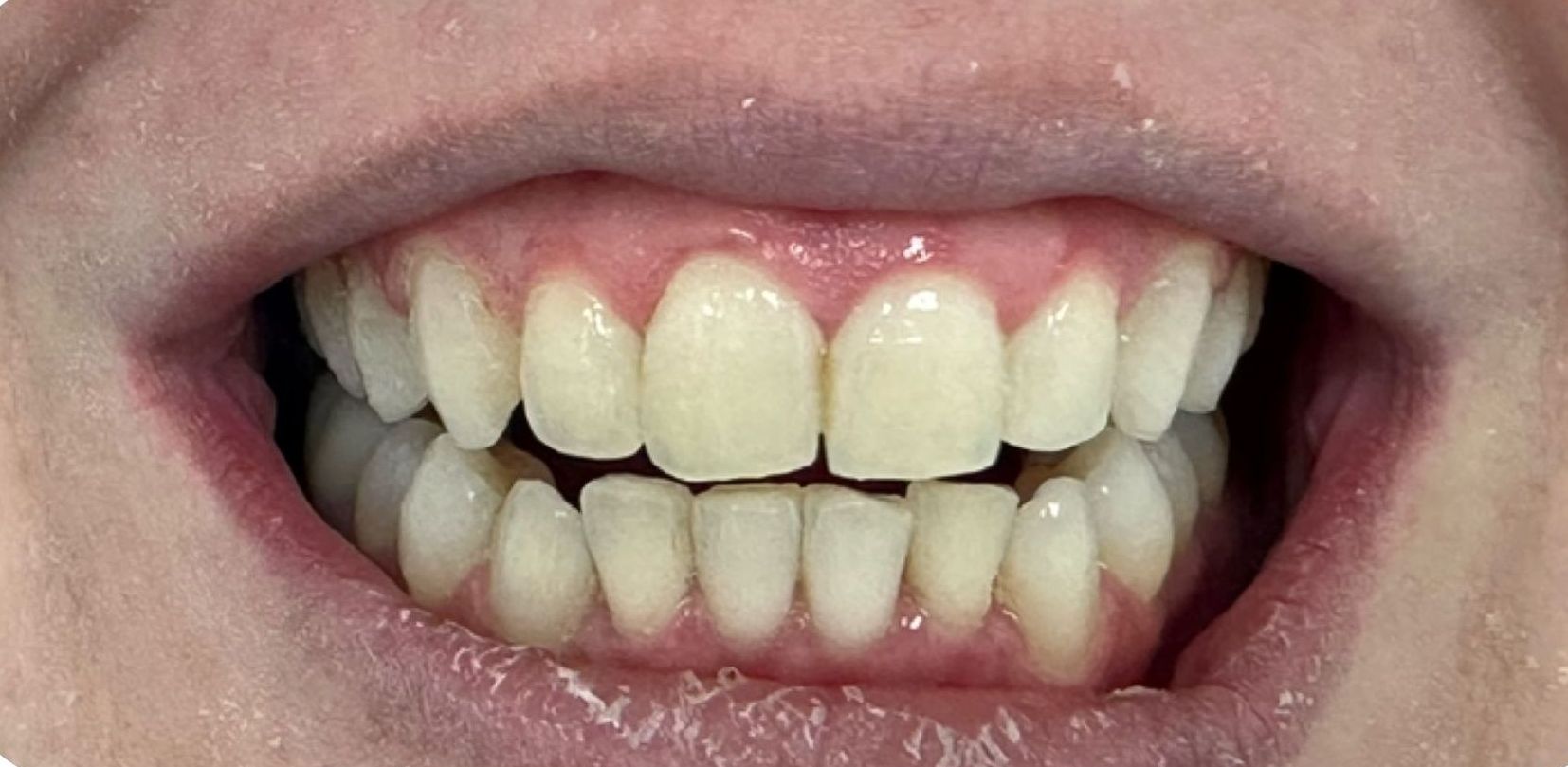 Close-up of a smiling mouth showing slightly misaligned front teeth