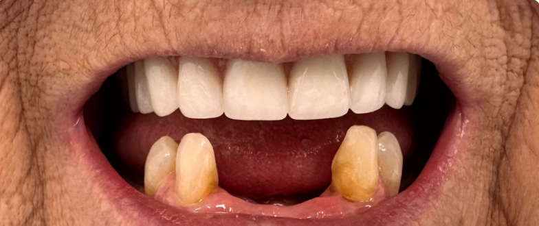 Close-up of a mouth with missing front teeth and yellowed teeth