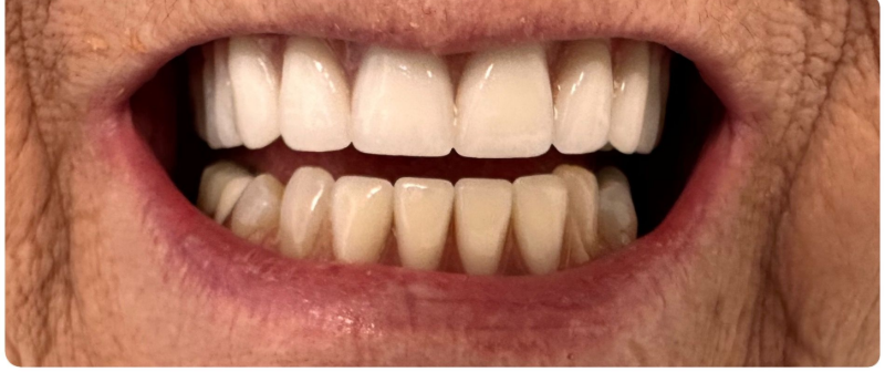 Close-up of a smiling mouth with white upper teeth and discolored lower teeth