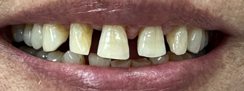 Close-up of a mouth with missing front teeth and yellowed teeth, lips slightly parted