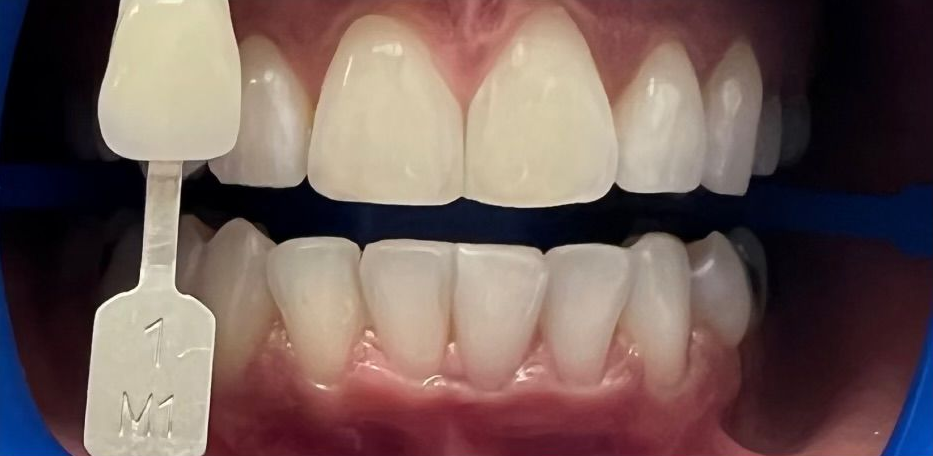 Close-up of teeth with a shade guide matching the upper front teeth