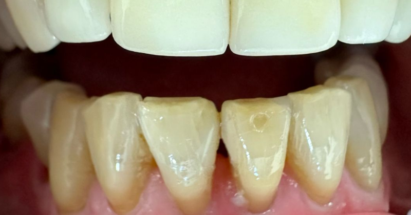 Close-up of yellowed lower teeth beneath white upper teeth, mouth slightly open