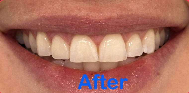 Close-up of a smiling mouth with straight white teeth and the word “After” in blue.