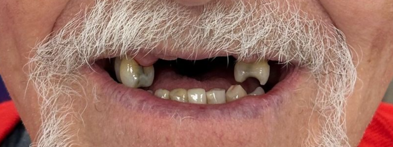 Close-up of a mouth with missing and crooked teeth and a white mustache.