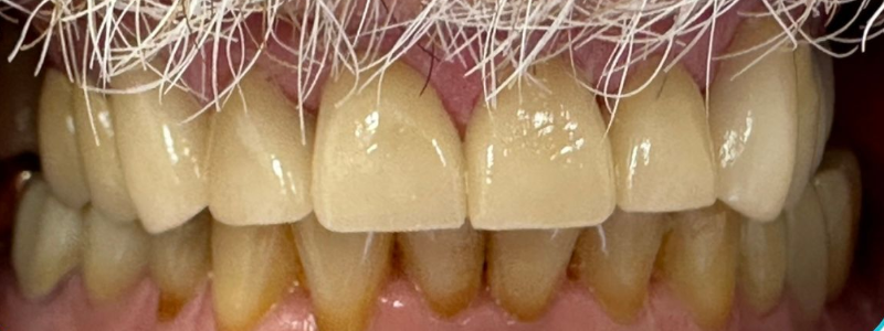 Close-up of stained human teeth, with white upper teeth and yellow-brown lower teeth.