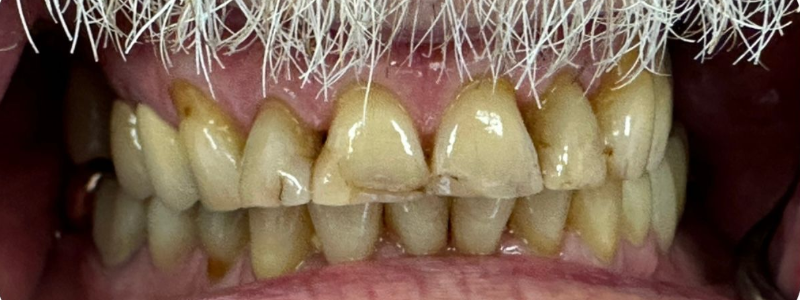Close-up of yellowed, crowded teeth with white facial hair above the mouth