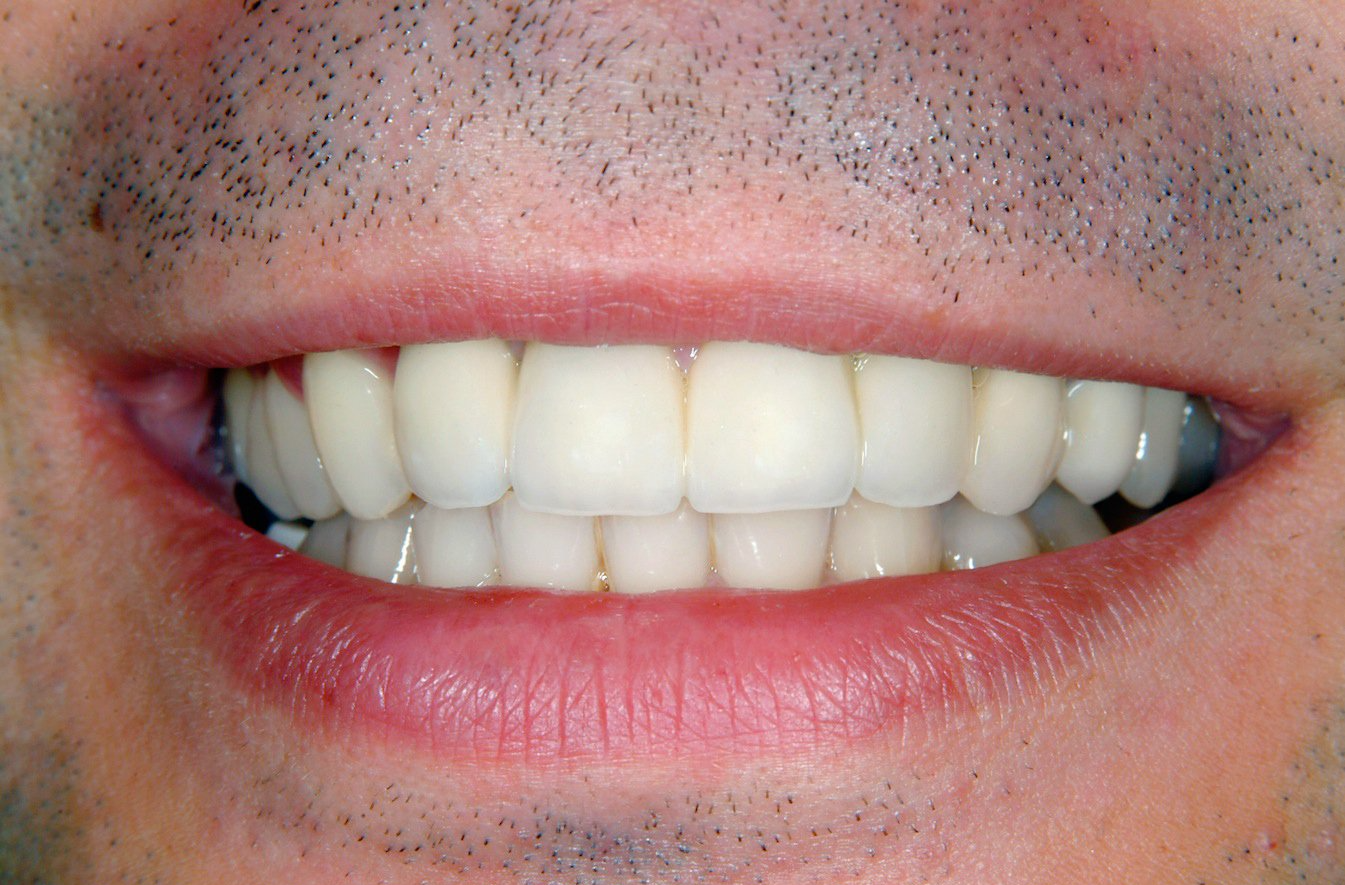 Close-up of a smiling mouth showing white teeth and light facial stubble.
