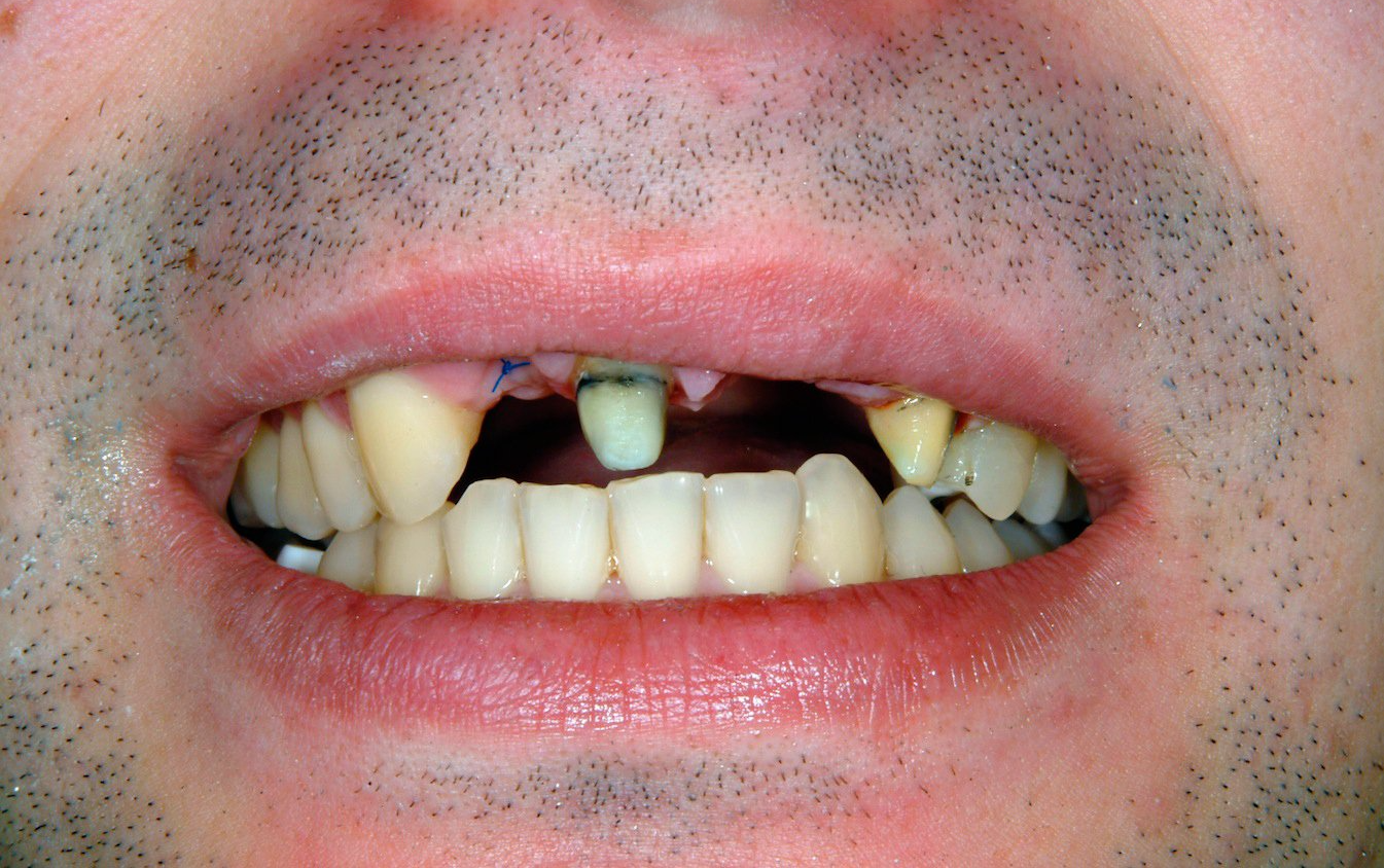 Close-up of a mouth with missing upper front teeth and one prominent tooth-like cap or implant
