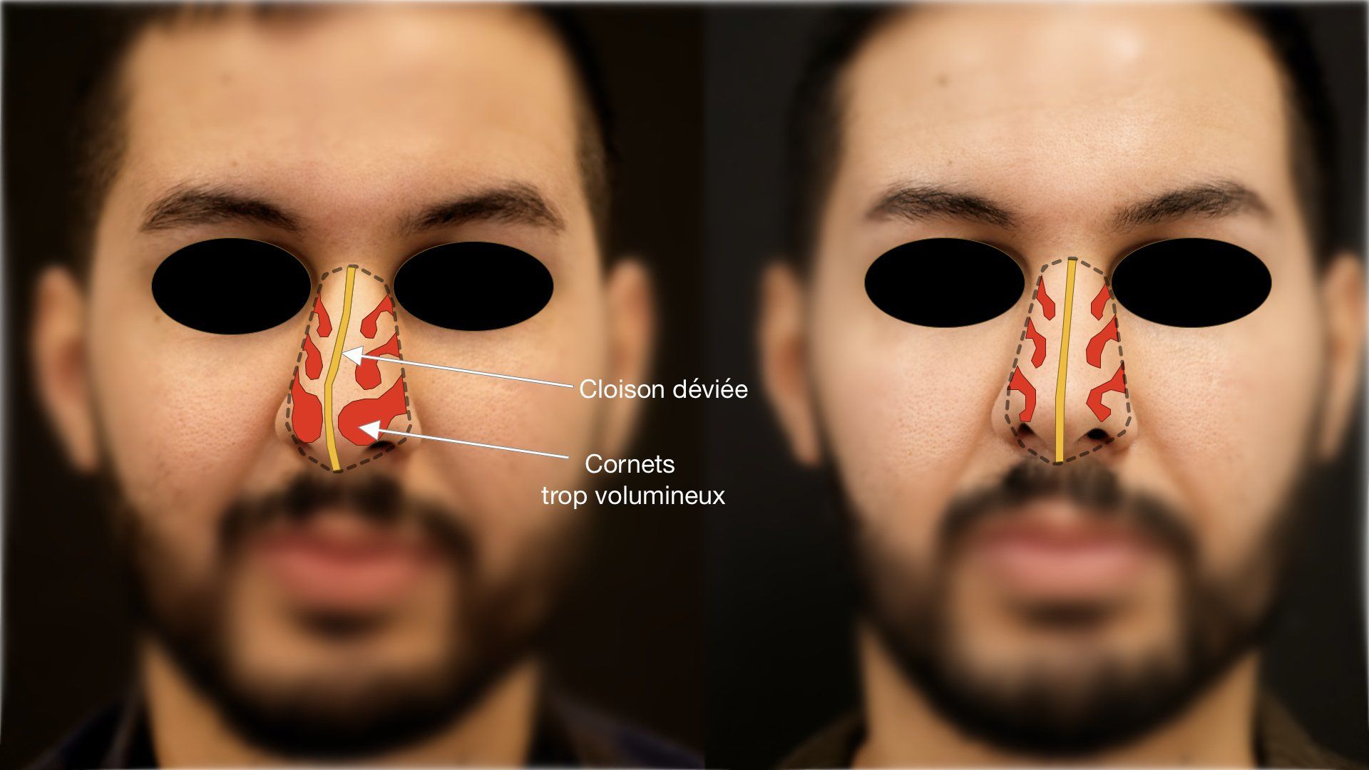 consultation pour septoplastie