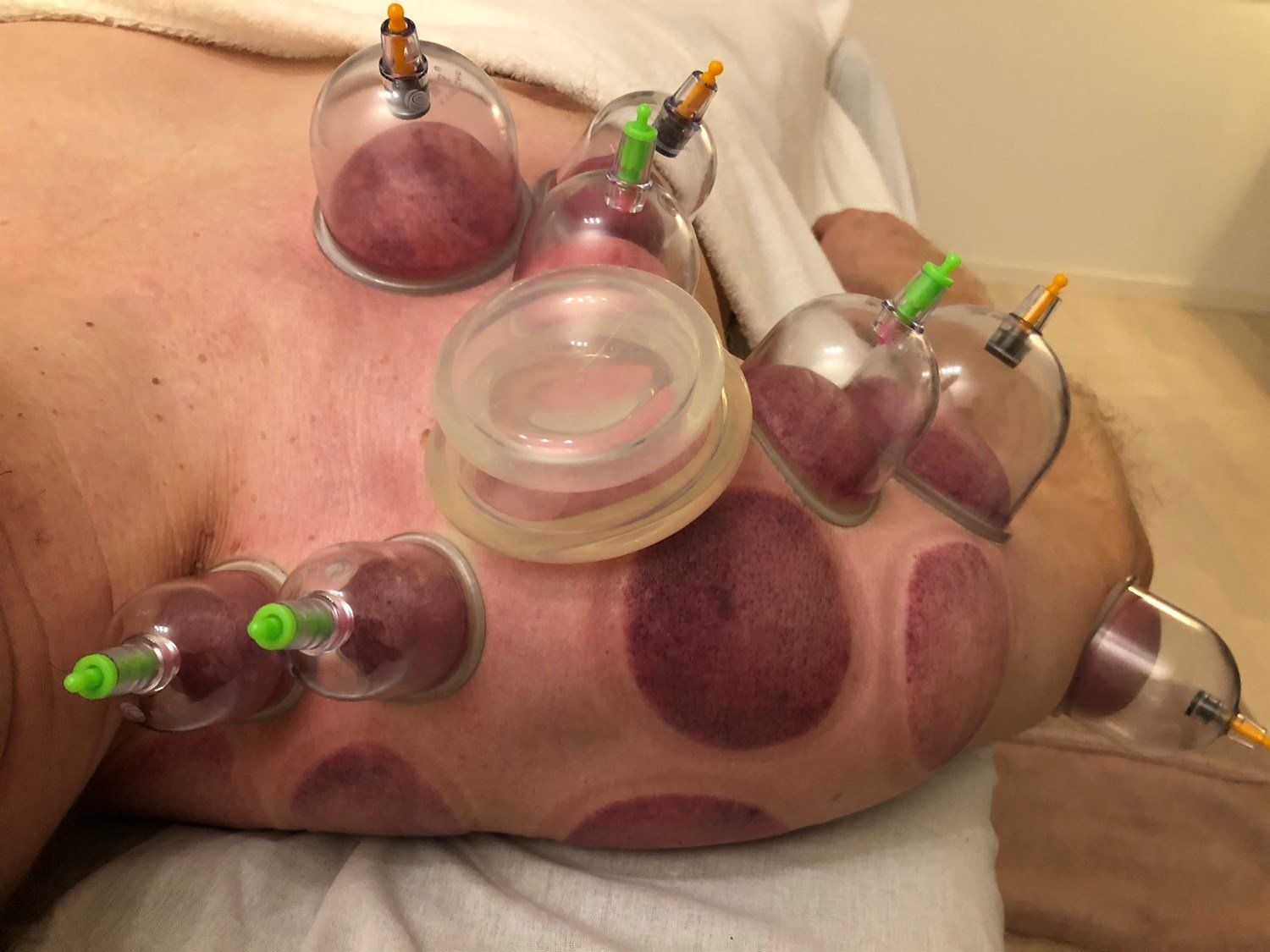 cupping massage therapy