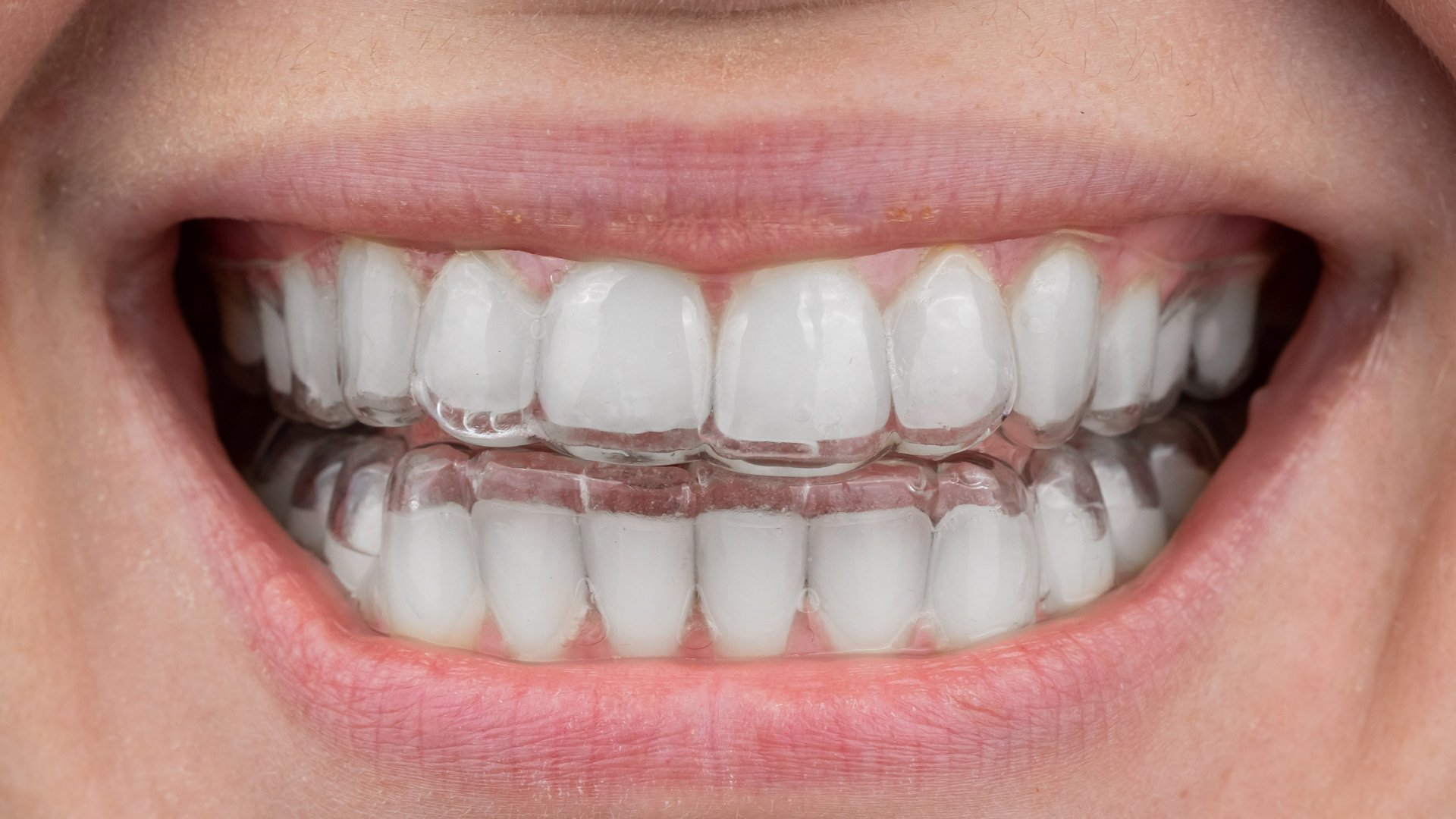 Clear Aligners Pittsburgh Gregory Peterson, DMD & Associates