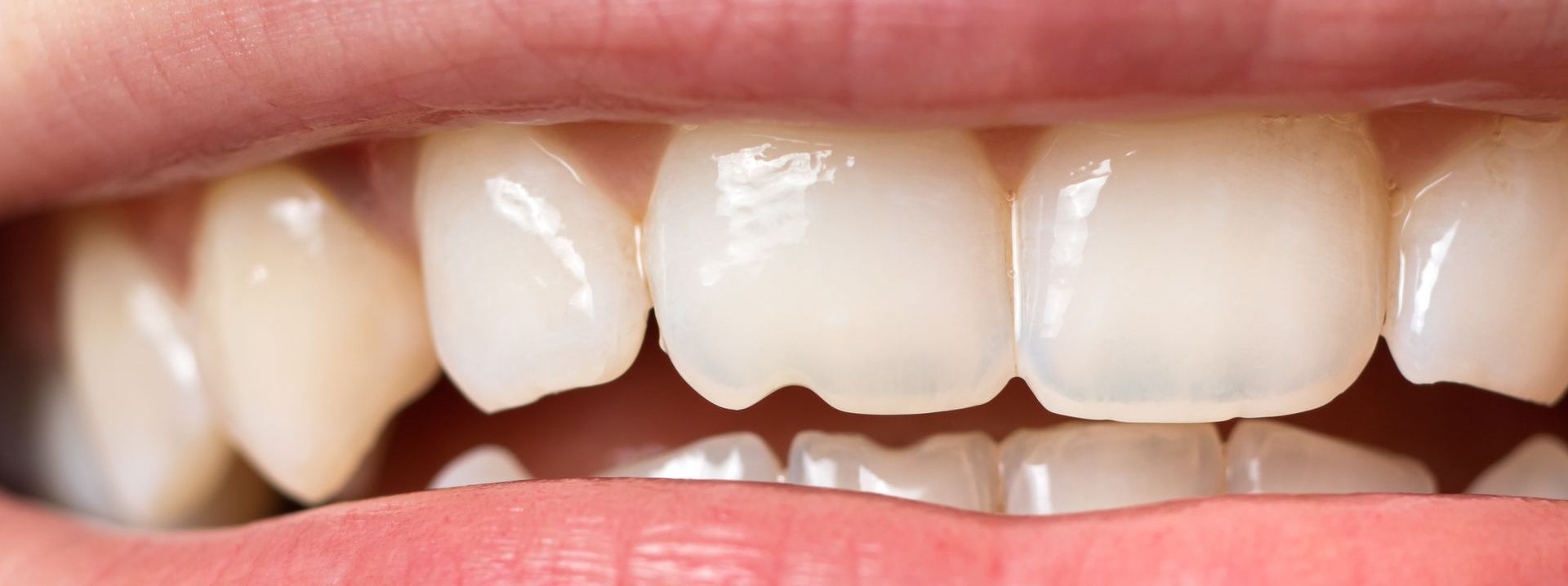 a chipped tooth