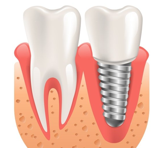 Dental Implant Cross Section Illustration