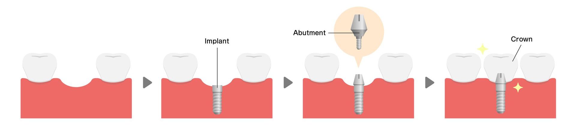 The parts of a dental implant The parts of a dental implant