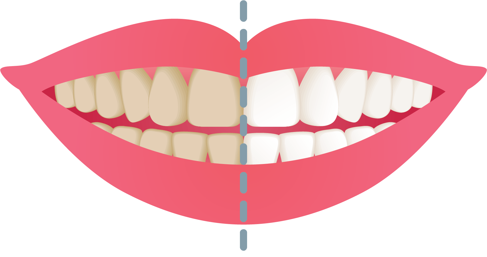 Teeth whitening example