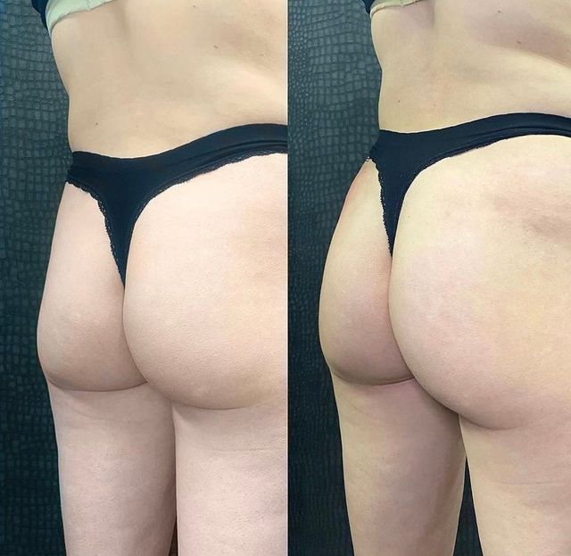 Non-Surgical Butt Lifts in Branford CT| Pure Skin Medspa