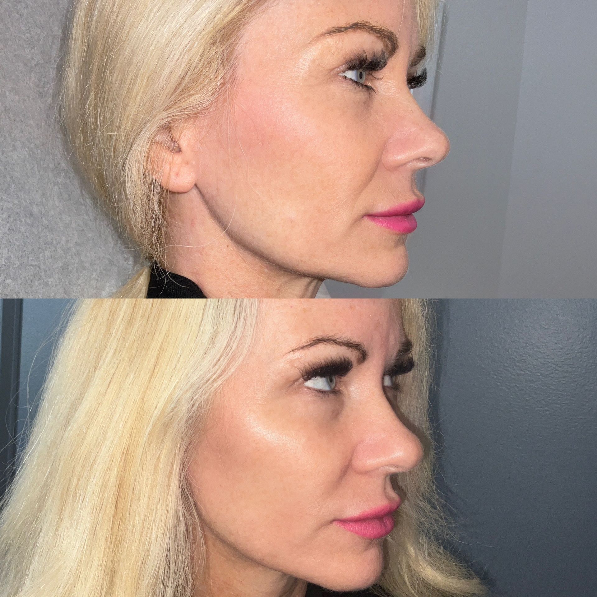  Facial Filler Before and After