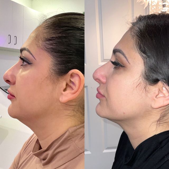 KYBELLA® Provider in Connecticut | Pure Skin MedSpa