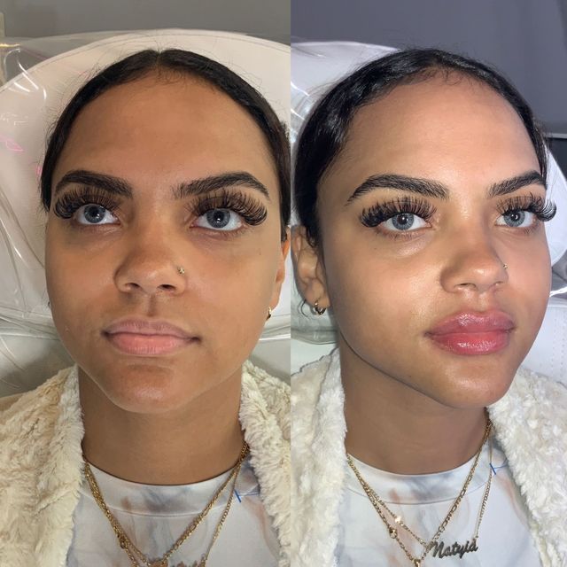 lip filler new haven c Fillers in Branford & East CT Pure Skin Medspa 602
