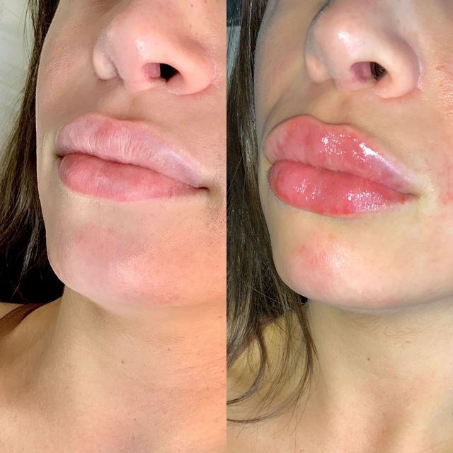Lip Fillers in CT - Pure Skin MedSpa - New Haven County CT