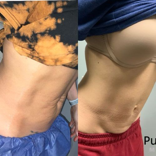 Profound Before and After