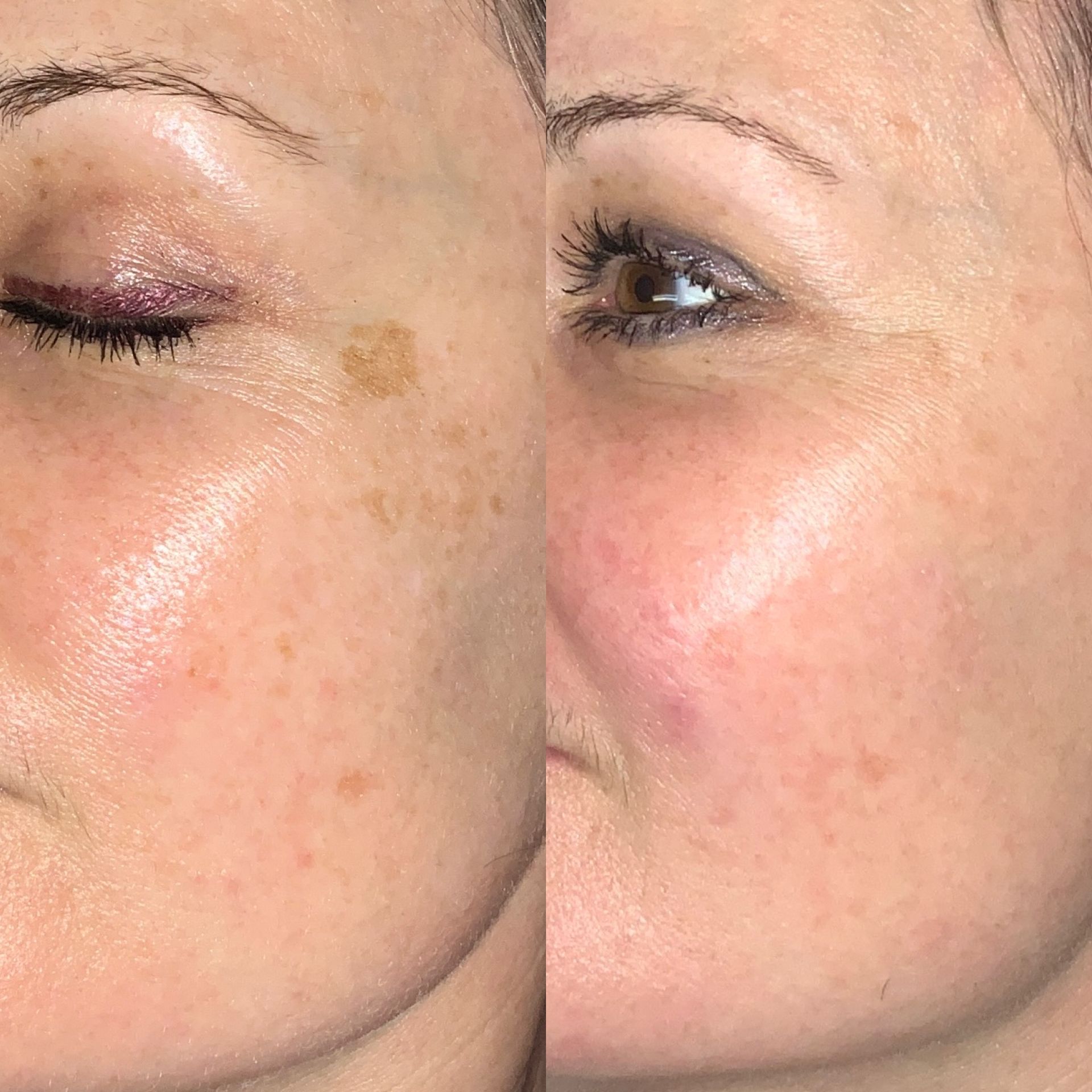 IPL Photofacial Before and After