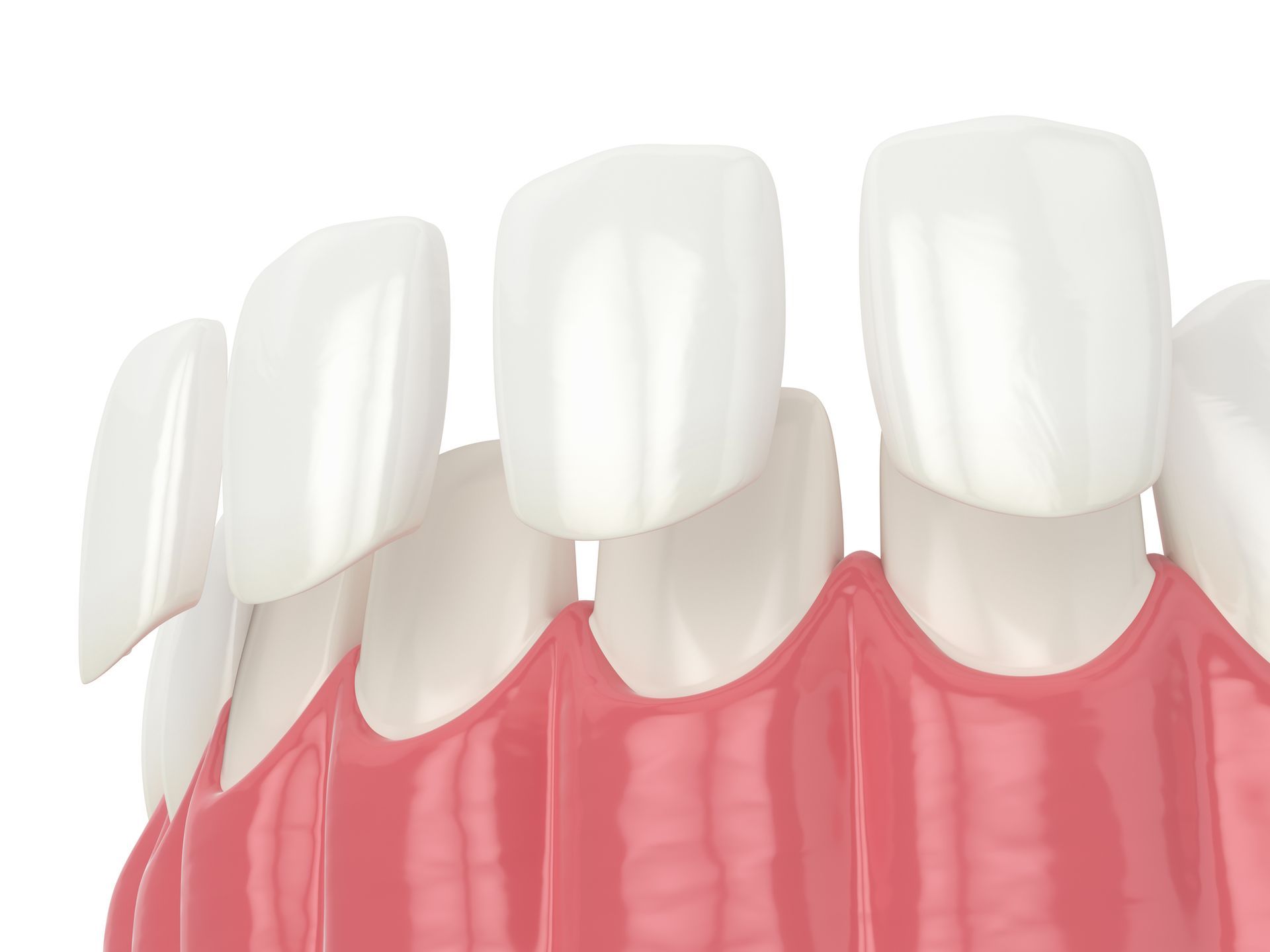dental trauma management McMaster University Gardens | Cosmetic dental bonding McMaster University Gardens