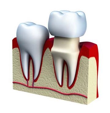 A model of a tooth with a crown on it