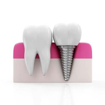 A 3d rendering of a tooth and a dental implant.