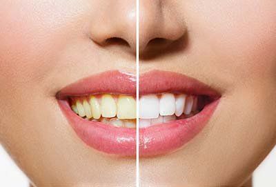 A woman 's teeth before and after whitening.