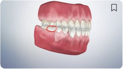 A close up of a model of a person 's teeth with braces.