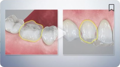 A picture of a tooth with a filling and a picture of a tooth without a filling.