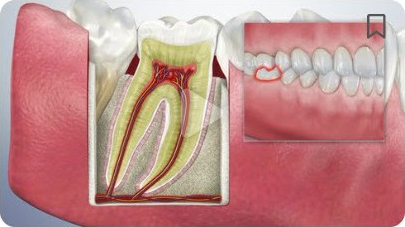 A close up of a tooth with a hole in it.