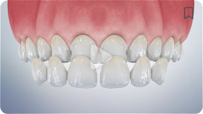 A close up of a person 's teeth with a broken tooth.