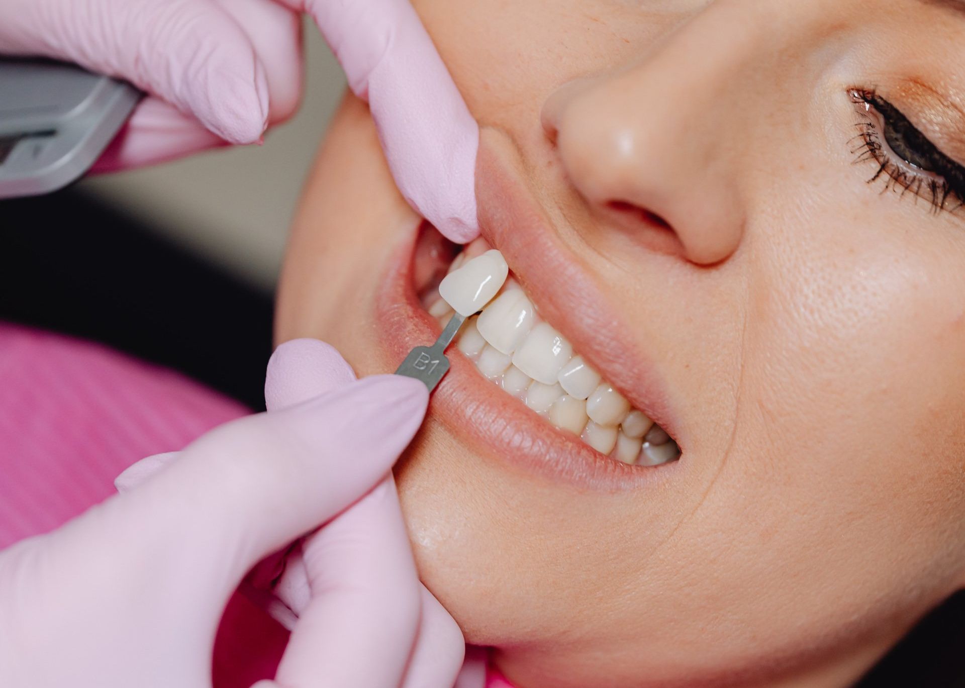 Colombian Dentist Applying Porcelain Veneers