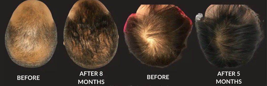 A before and after picture of a person 's hair growth.
