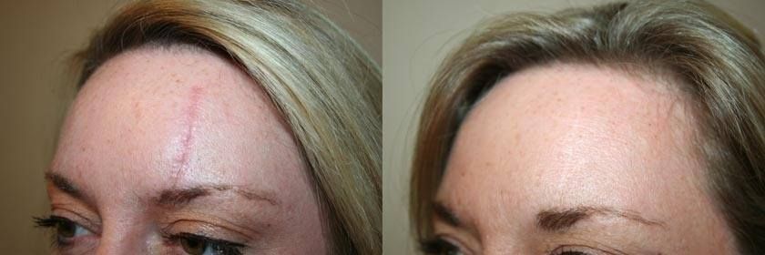 A before and after photo of a woman 's forehead with a scar.