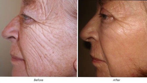 Co2 Fractional Laser