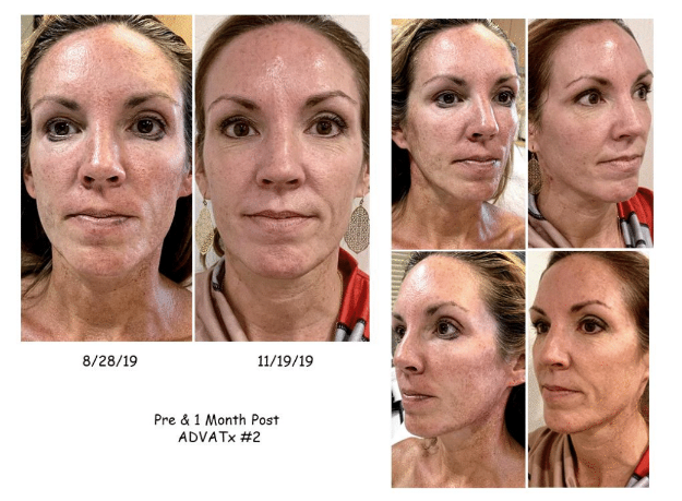 A woman 's face is shown before and after a treatment.