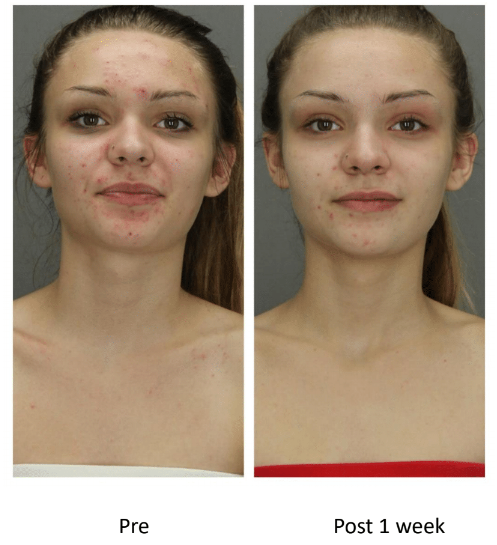 A before and after photo of a woman 's face