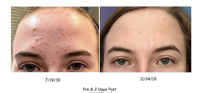 A before and after picture of a woman 's face with acne